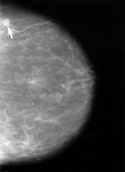 Mammogram of a breast showing a cancerous growth.